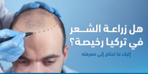 كم تكلفة زراعة الشعر في تركي