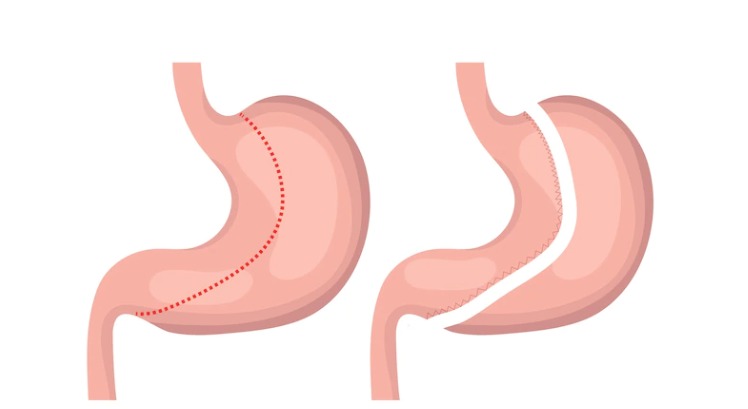 جراحة تكميم المعدة
