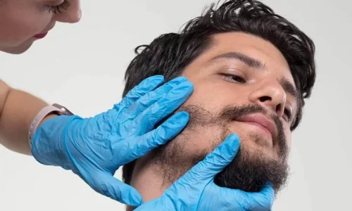 Beard Transplant