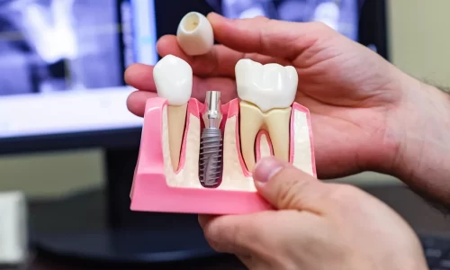 dental implantation