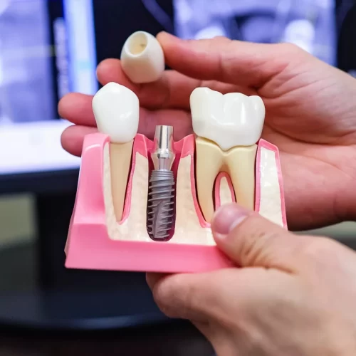 dental implantation