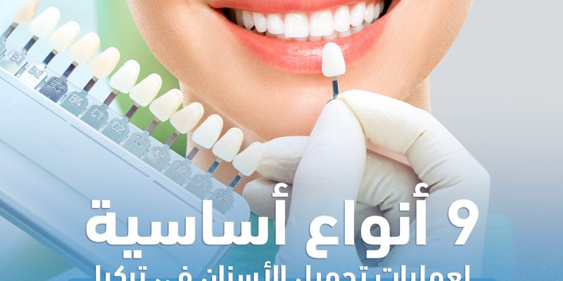 9 أنواع أساسية لعمليات تجميل الأسنان في تركيا..تعرّف عليها